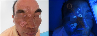 面部白斑三余年,在我院成功康复