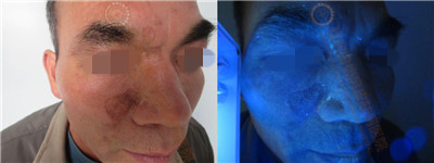 面部白斑三余年,在我院成功康复