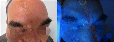 面部白斑三余年,在我院成功康复